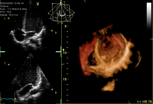 3 boyutlu Ultrasonda Kalp atışı...