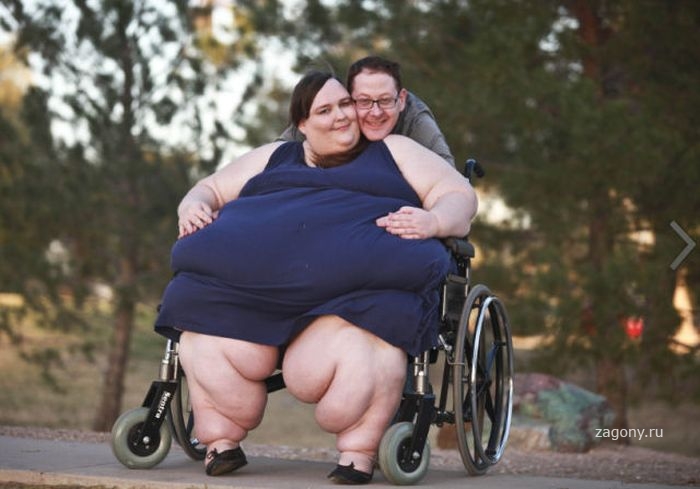 Sismanlik (obezite ) birçok kronik hastalığa neden oluyor!