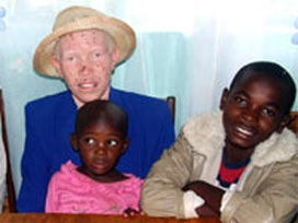 Burundi'de albino çocuğun cesedi bulundu 