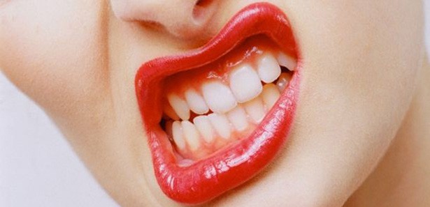 Dişteki bakteri kanser nedeni 
