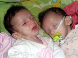 Eskişehir'de ölen ikizlerden doku örnekleri alındı 