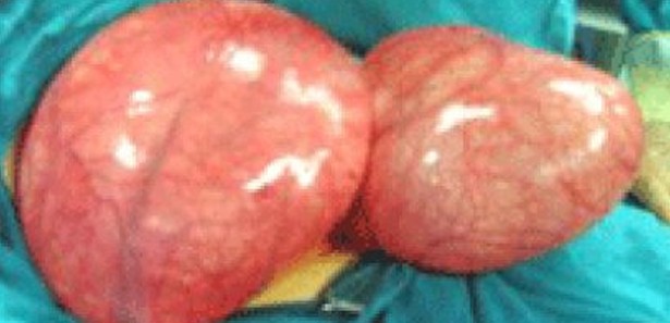 Rahminden futbol topu büyüklüğünde tümör çıkarıldı 
