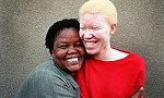 Albinizm Ve Albinolar???-albinojpg