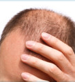 Erkekte Saç Dökülmesi